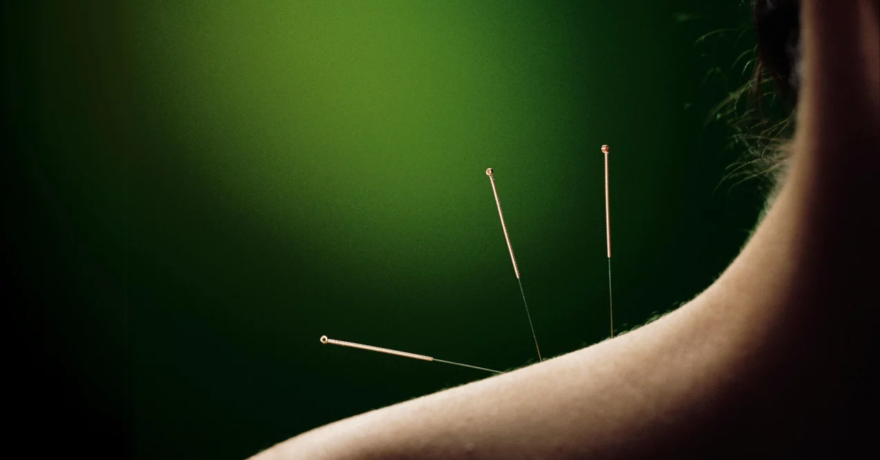 Three acupuncture needles in the neck,