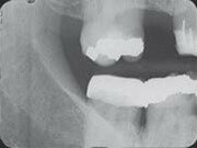 Dental X-Ray