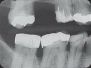 Dental X-Ray