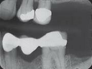 Dental X-Ray