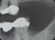 Dental X-Ray