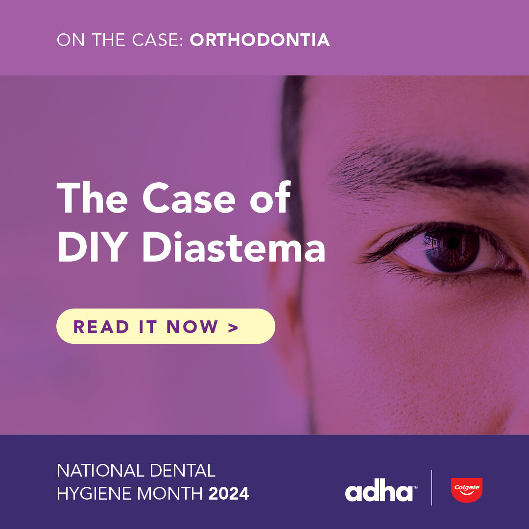 The Case of DIY Diastema