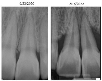 Periapical radiograph from 2020 to 2022